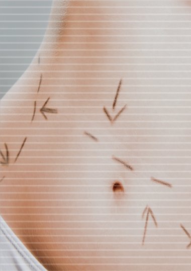 cirugías de abdomen