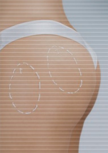 cirugías para glúteos y espalda